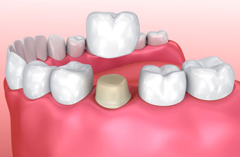 CEREC Crowns Grandville MI Dentist CEREC Crowns Grandville MI Dentist