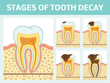 Dental Crowns Grandville MI Dentist