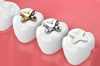 Dental Fillings Grandville MI Dentist Dental Fillings Grandville MI Dentist